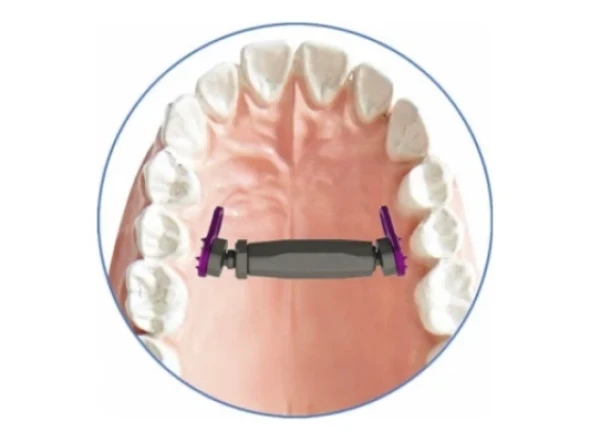 Implantes ortopédicos Sistema Distrator MICRO DISTANCE PALATAL