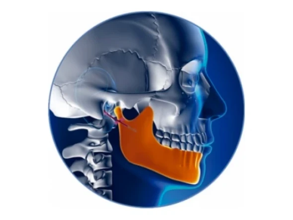 	Implantes ortopédicos Distrator MICRO DISTANCE TERÇO MÉDIO