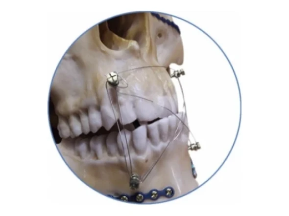 Implantes ortopédicos Parafuso MICRO SCREW