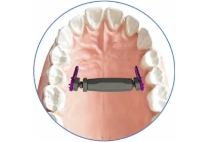 Distrator MICRO DISTANCE PALATAL