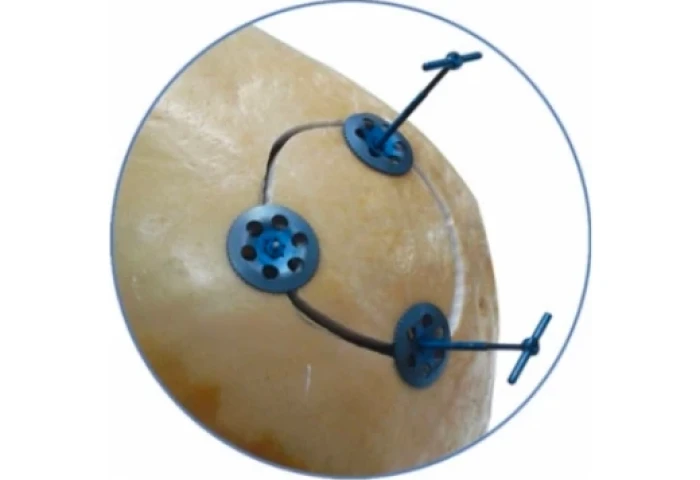 Botão de Fechamento de Crânio MICRO NEURO